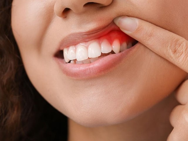 Cómo prevenir enfermedades periodontales