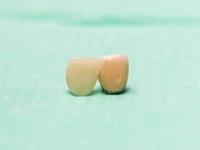 Coronas de zirconio: beneficios de estas fundas dentales