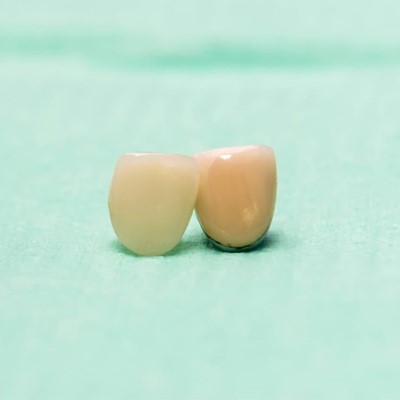 Coronas de zirconio: beneficios de estas fundas dentales