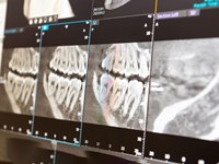 ¿Cuándo es necesario extraer las muelas del juicio?