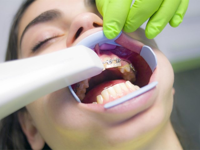 ¿Cuánto tiempo de media dura un tratamiento de ortodoncia? 