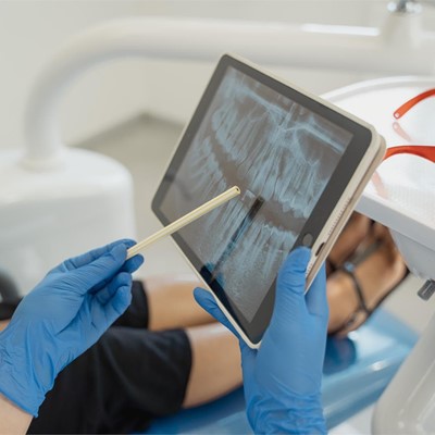 Diferencias entre la gingivitis y la periodontitis