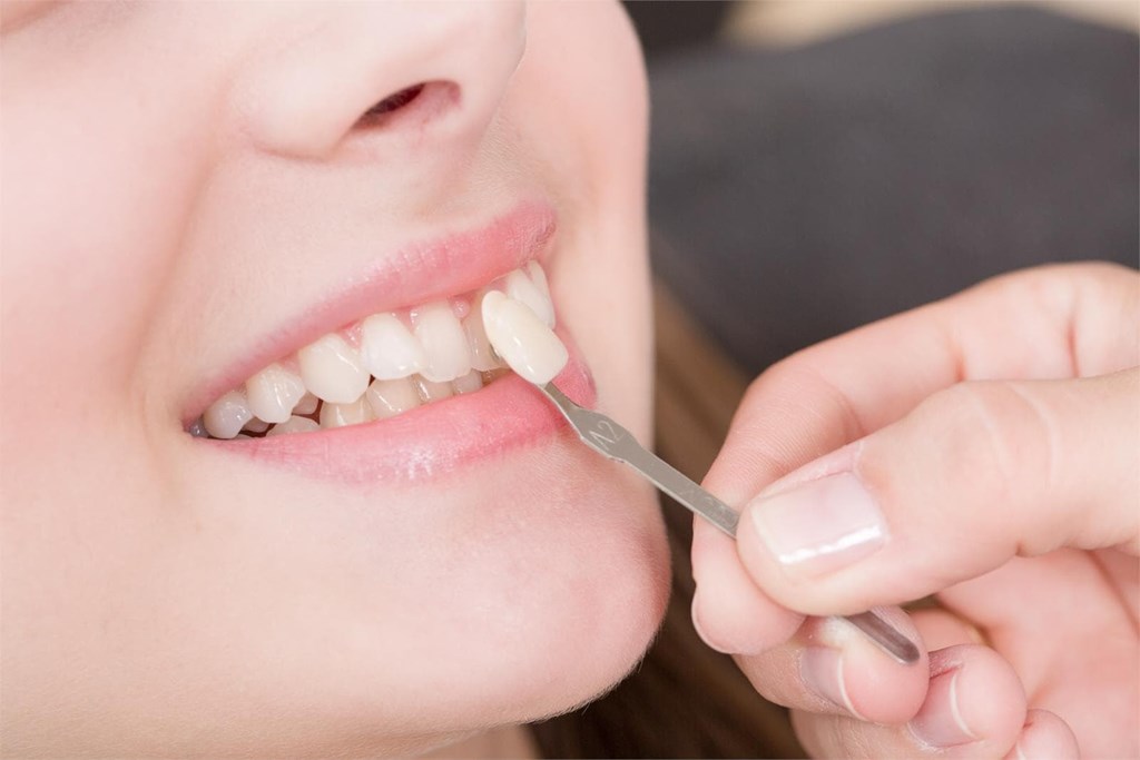 Diferencias entre los distintos tipos de restauraciones dentales