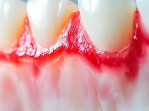 Gingivitis: causas, tratamiento y prevención