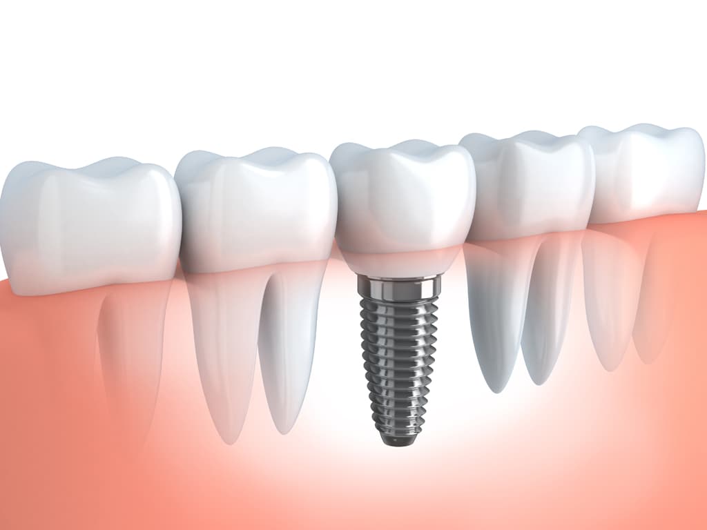 El mejor precio para sus implantes dentales