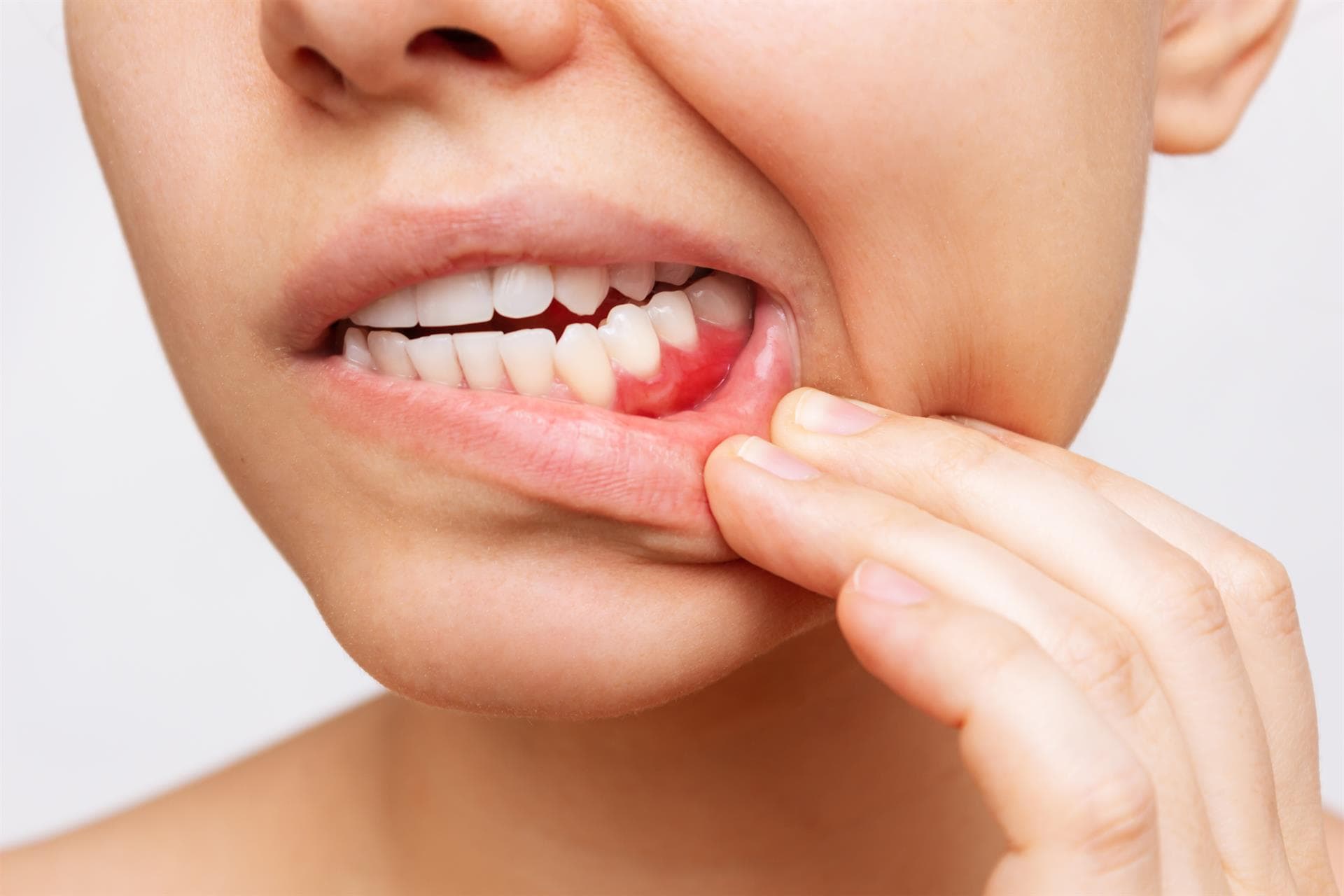 Olvidate de la gingivitis y periodontitis