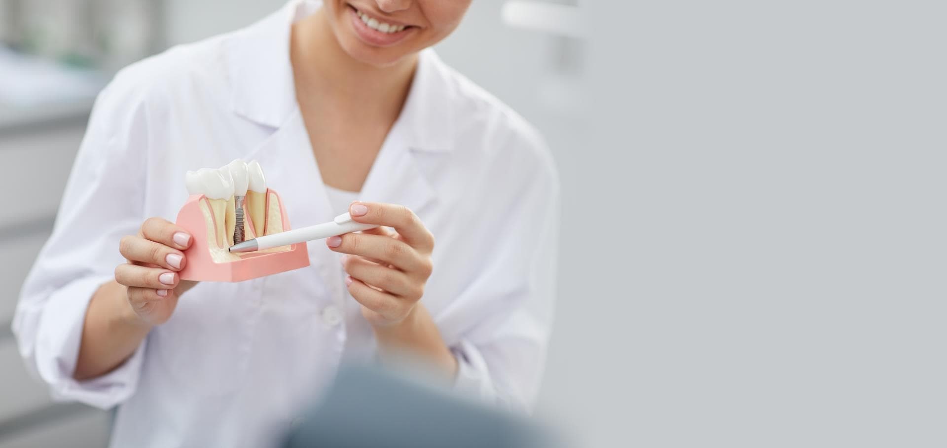 Implantes dentales, la solución que buscabas
