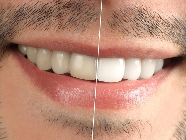 Lo que debes conocer antes de un blanqueamiento dental 