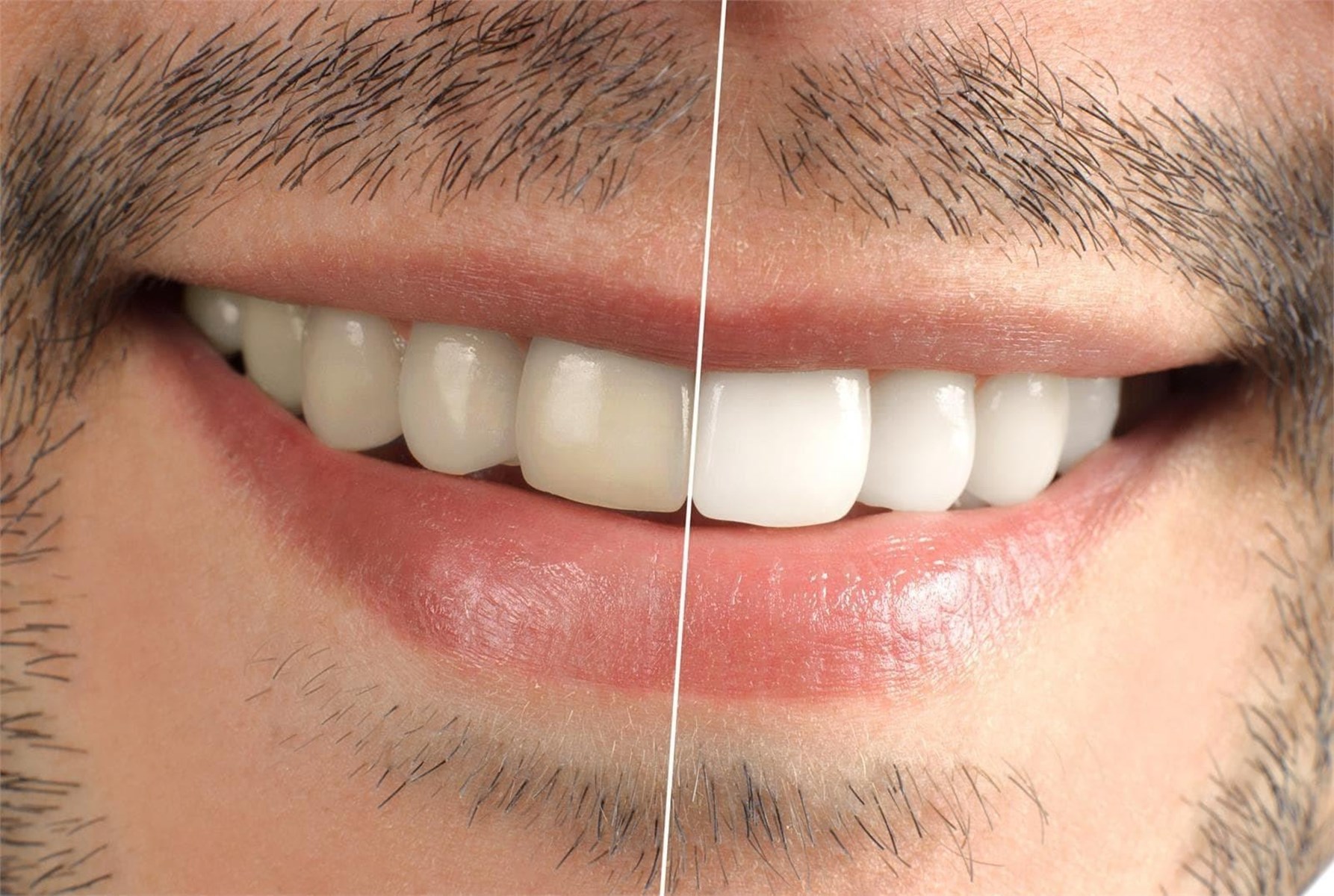 Lo que debes conocer antes de un blanqueamiento dental 