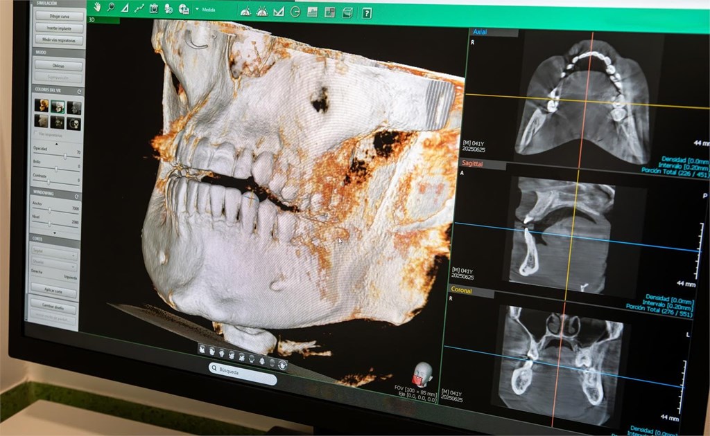 ¿Qué tener en cuenta antes de someterse a un tratamiento de implantes dentales?