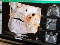 ¿Qué tener en cuenta antes de someterse a un tratamiento de implantes dentales?
