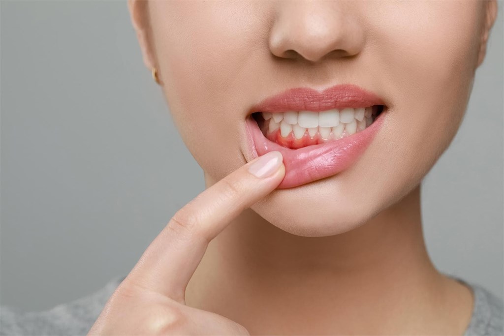 ¿Sangran tus encías? Podría ser gingivitis. ¡Actúa antes de que sea tarde!