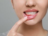 ¿Sangran tus encías? Podría ser gingivitis. ¡Actúa antes de que sea tarde!
