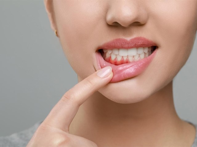 ¿Sangran tus encías? Podría ser gingivitis. ¡Actúa antes de que sea tarde!