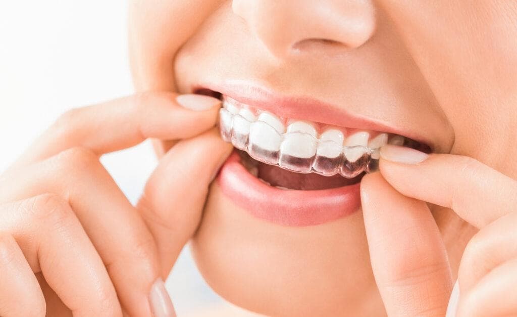 Trucos para mantener limpia tu ortodoncia invisible
