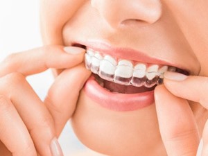 Trucos para mantener limpia tu ortodoncia invisible