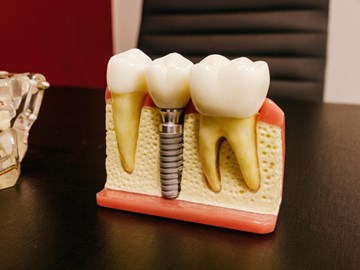 Ventajas de los tratamientos con implantes dentales