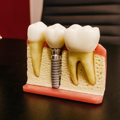 Ventajas de los tratamientos con implantes dentales